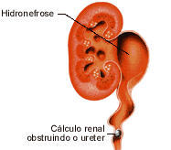 Clculo Renal